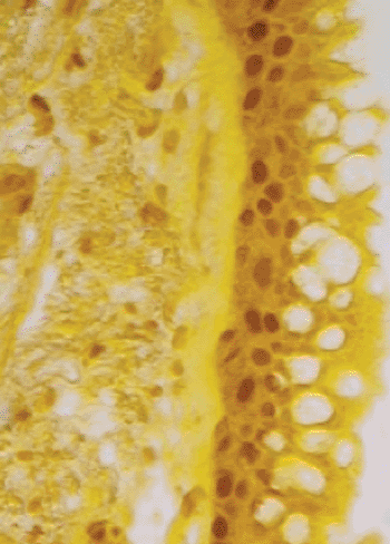 Image: This photomicrograph depicts airway epithelial cells from lung tissue of a COPD patient. The cell nuclei have been stained to reveal IL-33, a type of signaling molecule found at high levels in COPD patients. New research shows that viral infection can induce these cells to proliferate. Release of IL-33 from these cells promotes inflammatory mucus production. These findings provide insight into the mechanisms linking acute infection to chronic inflammatory lung disease (Photo courtesy of Holtzman Lab, Washington University School of Medicine).